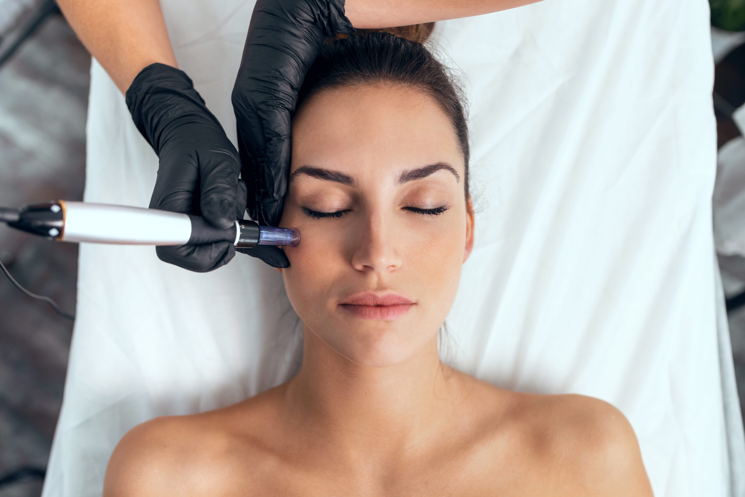 Microneedling in Essen