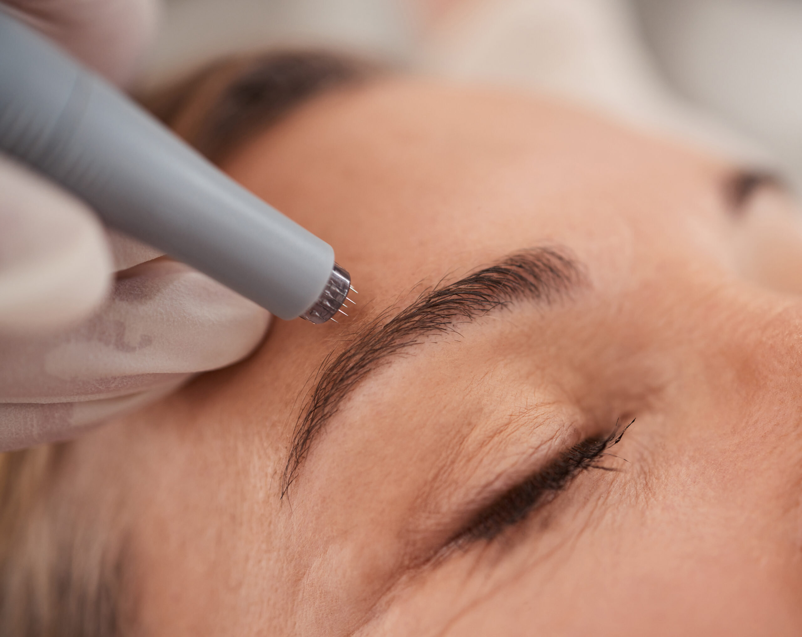 Schulung für Microneedling in Essen